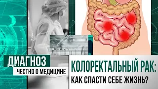 Жизнь без стомы: как при раке прямой кишки сохранить сфинктер | Диагноз