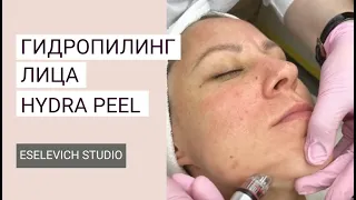 Вакуумная чистка лица Hydra Peel. Гидропилинг и его свойства.