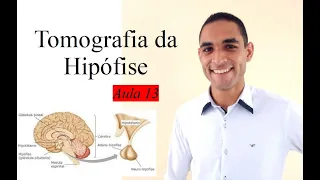 Curso de Tomografia C/Contraste - Aula 13 (Hipófise)