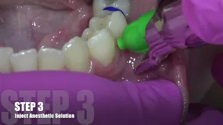 Extraction with Intrarosseous Anesthesia