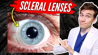 Scleral Lenses for Keratoconus: 7 Facts You Need to Know