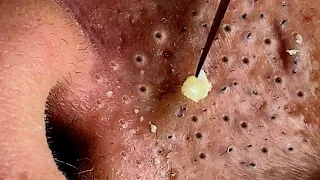 large blackheads and pimples removal satisfying video NASA SPA