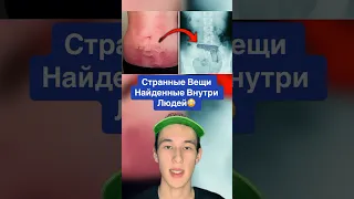 Самые Странные Вещи Найденные Внутри Людей!😳  #shorts #спанчбоб #доктор