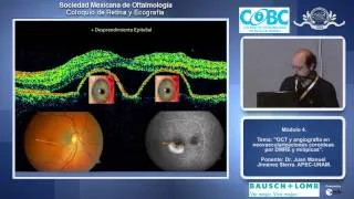 OCT y angiografía en neovascularizaciones coroideas DMRE y miópicas - Dr. Juan Manuel Jiménez Sierra