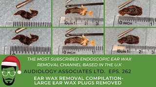 EAR WAX REMOVAL COMPILATION - LARGE EAR WAX PLUGS REMOVED - EP 262