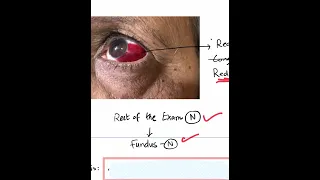 Sub-Conjunctival Hemorrhage (SCH) - Case Discussion In A Minute #Shorts