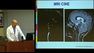 Chiari Malformations & Current Research in the Field