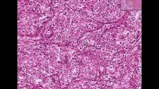 Histopathology Kidney--Renal cell carcinoma (hypernephroma)