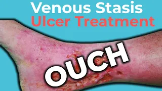 Venous Stasis Ulcer Treatment | Wound Care OC