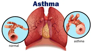 Asthma  I  Causes, Symptoms, Prevention, & Treatment