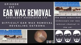 DIFFICULT EAR WAX REMOVAL REVEALING OSTEOMA - EP357