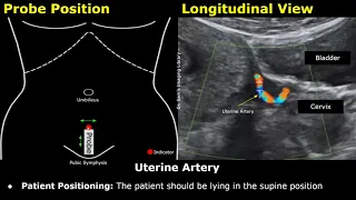 How To Scan The Uterine Artery | Doppler Ultrasound Probe Positioning | Transducer Placement USG