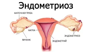 Эндометриоз и молочные продукты (Нил Барнард)