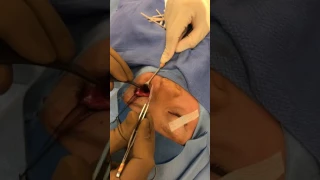 Orbital Blow Out Fracture - Baseball Injury on Child