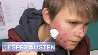 Riesen Pickel ausgedrückt: Hat er jetzt eine Blutvergiftung? | Die Spezialisten | SAT.1 TV