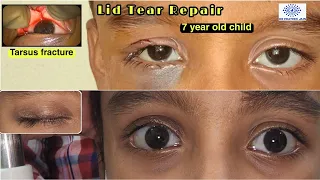 #118 Tarsal plate Repair | Triple layer suturing of Lid tear in a child @DrPrateekJain_eye