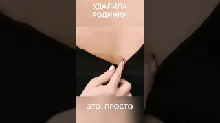 Удалила родинки - Это просто