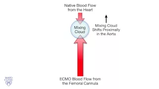 Femoral Cannulation and Veno-Arterial ECMO - Mayo Clinic