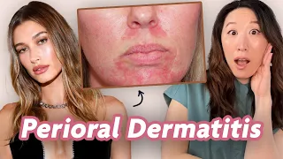All Things Perioral Dermatitis! Reaction & Treatment Tips | Dr. Joyce Dermatologist