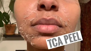 How I do My At Home Chemical Peel - Full process | كيف أقوم بعمل التقشير الكيميائي في المنزل