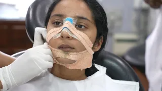 Indian Girl Jaw Surgery / Rhinoplasty | Pack Removal | Result After 7 Days