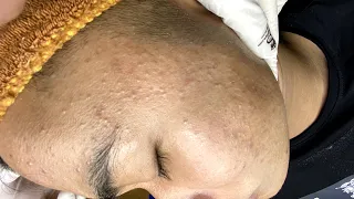 Best Pimple Popping | Siêu Mụn Đầu Đen - SacDepSpa#169