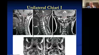 Chiari Over the Ages - Ask the Expert feat. Dr. Gerry Grant