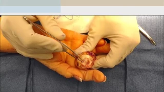 Finger Arthroplasty with Swanson Implants For Finger Arthritis