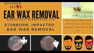 STUBBORN IMPACTED EAR WAX REMOVAL - EP 387