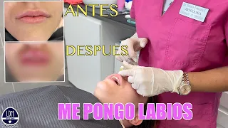 ME PONGO LABIOS👄RELLENO CON ÁCIDO HIALURÓNICO/Martina D´Antiochia