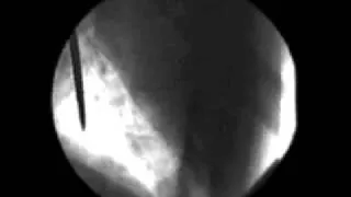 Sword swallower video by x-ray (J. Koufman)