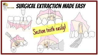 Easy ways to section teeth for SURGICAL EXTRACTION | Open extraction@GlidewellDental  @osmosis