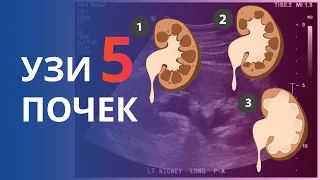 УЗИ почек. Часть 5. Степени Гидронефроза и его дифференциаьная диагностика