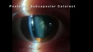 Posterior Subcapsular Cataract (PSC)