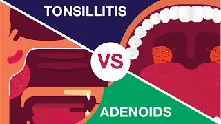 What is Adenoids and Tonsillitis? (Complete Video)