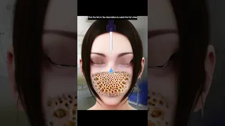 ASMR Treatment Serious Wound on the Face Maggot Removal Animation