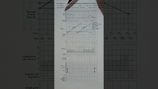 Prolonged active phase of labour as seen on the partograph