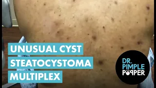 An Unusual Cyst  Steatocystoma Multiplex