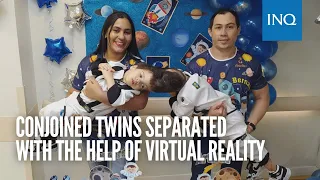 Conjoined twins separated with the help of virtual reality