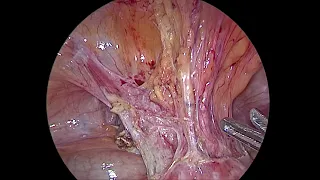 Lateral Window Technique for Bladder Dissection In Lap Hysterectomy