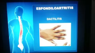 Espondiloartritis - Medicina V UDO