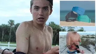 Teen Surfer Survives Shark Attack Despite Wearing Band Meant To Repel Them