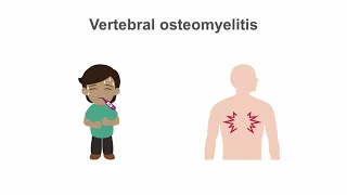 How to treat osteomyelitis