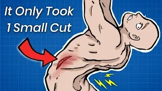 How 1 Small Cut Can Break Your Spine