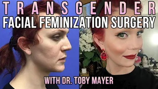 Transgender Facial Feminization Surgery Before And After - Dr. Toby Mayer