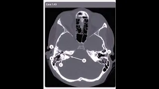 High Resolution Axial CT Temporal Bone