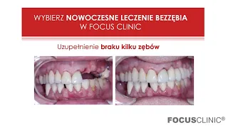 NOWOCZESNE LECZENIE BEZZĘBIA