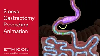 Sleeve Gastrectomy Procedure Animation