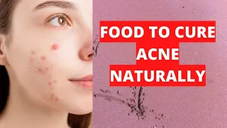 Food To Cure Acne Naturally / Traditional Way To Get Rid Of Acne / Bestie Health