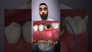 ايه هو خراج الأسنان (اسباب وعلاج) ؟ #dental #dentist #خراج_الأسنان #أسنان #دكتور_اسنان #التهاب_اللثة